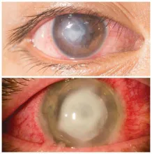 Owrzodzenie rogówki