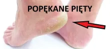 popękane pięty przyczyny