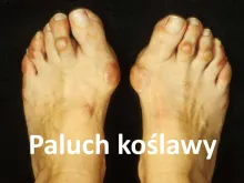  Paluch koślawy