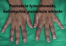Paznokcie łyżeczkowate, koilonychia, paznokcie wklęsłe