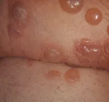 Pemfigoid pęcherzowy