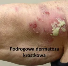 Podrogowa dermatoza krostkowa 