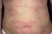 Pokrzywka alergiczna