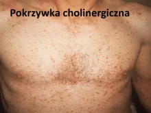 Pokrzywka cholinergiczna 