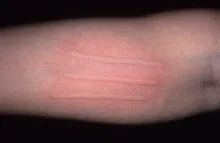 Pokrzywka dermograficzna