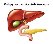 Polipy woreczka żółciowego