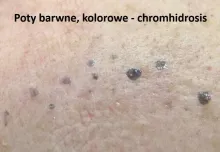 Poty barwne, chromhidrosis 