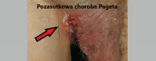 Pozasutkowa choroba Pageta