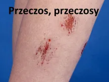Przeczos, przeczosy 