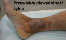 Przewlekła niewydolność żylna