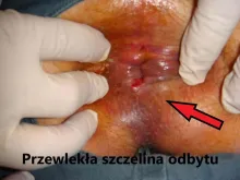 Przewlekła szczelina odbytu