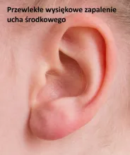 Przewlekłe wysiękowe zapalenie ucha środkowego 