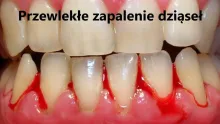 Przewlekłe zapalenie dziąseł