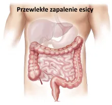 Przewlekłe zapalenie esicy