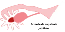Przewlekłe zapalenie jajników