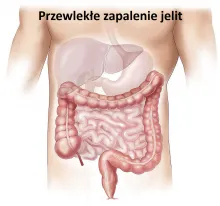 Przewlekłe zapalenie jelit