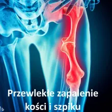 Przewlekłe zapalenie kości i szpiku