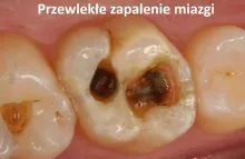 Przewlekłe zapalenie miazgi