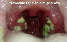 Przewlekłe zapalenie migdałków 