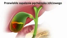 Przewlekłe zapalenie pęcherzyka żółciowego 