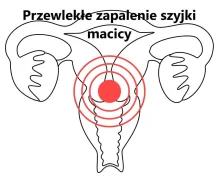 Przewlekłe zapalenie szyjki macicy 
