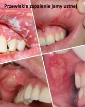 Przewlekłe zapalenie jamy ustnej