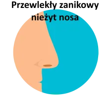 Przewlekły zanikowy nieżyt nosa, Zanikowy nieżyt nosa 