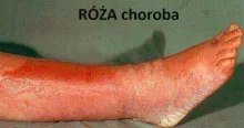 Róża choroba