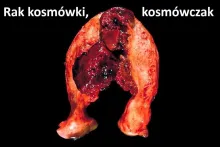 Rak kosmówki, kosmówczak, choriocarcinoma 