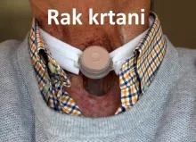 Rak krtani