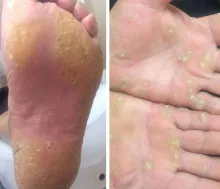 Rogowacenie skóry keratoderma