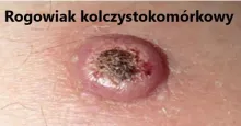  Rogowiak kolczystokomórkowy