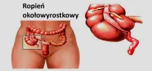 Ropień okołowyrostkowy, naciek  okołowyrostkowy 