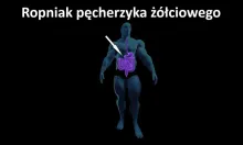 Ropniak pęcherzyka żółciowego 