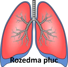 Rozedma płuc 