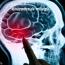 ROZRODCZAK MÓZGU, germinoma mózgu 