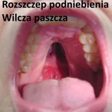 Rozszczep podniebienia, wilcza paszcza 