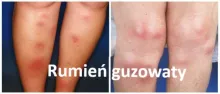 Rumień guzowaty 