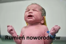 Rumień noworodkowy