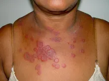 Rumień wielopostaciowy