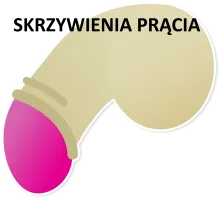 SKRZYWIENIA PRĄCIA, SKRZYWIENIE CZŁONKA, KRZYWIZNA PENISA 