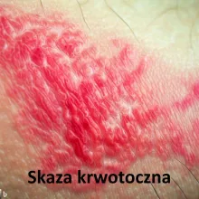 Skaza krwotoczna, plamica, purpura, bleeding tendencies, hemorrhagic diatheses