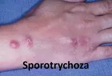 Sporotrychoza 