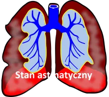 Stan astmatyczny 