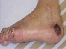 Stopa cukrzycowa 