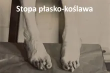 Stopa płasko-koślawa