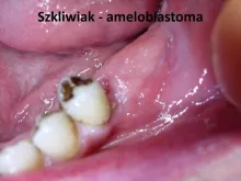 Szkliwiak ameloblastoma 