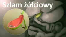Szlam żółciowy