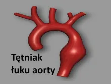 Tętniak łuku aorty 
