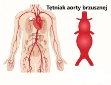 Tętniak aorty brzusznej 